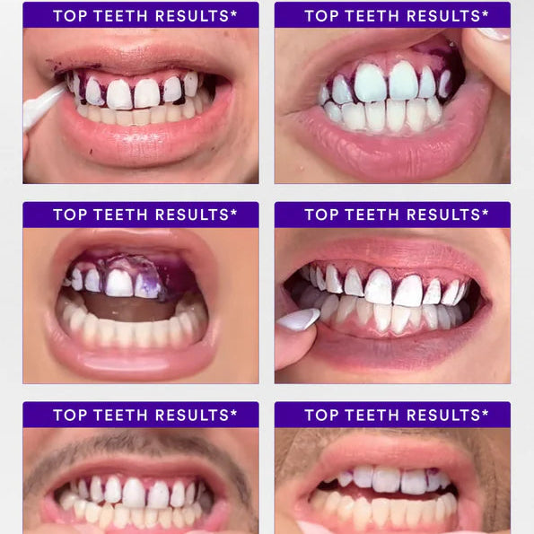 Volora Shine™ Purple Whitening Strips